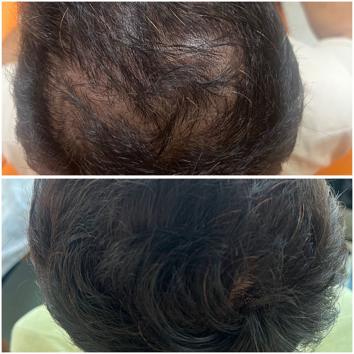 Hair regrowth before and after at Hi Girl
