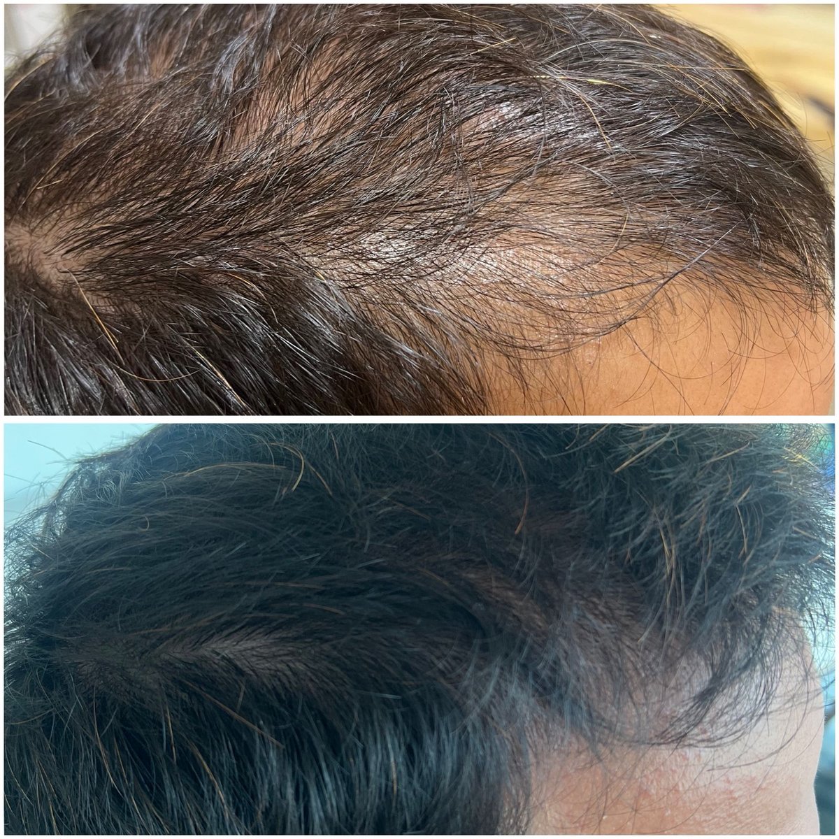 Hair regrowth before and after