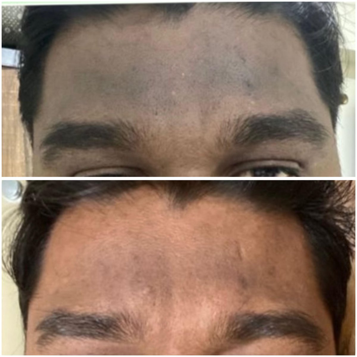 Hair growth after single GFC session
