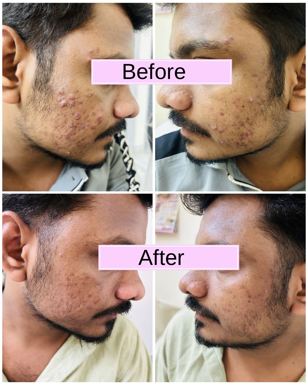 Lip filler before and after