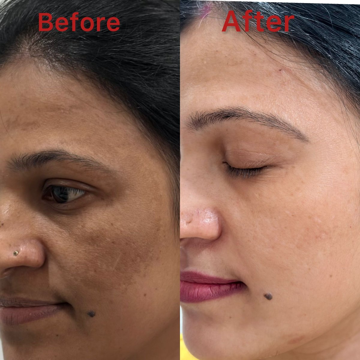 Pigmentation and melasma before and after