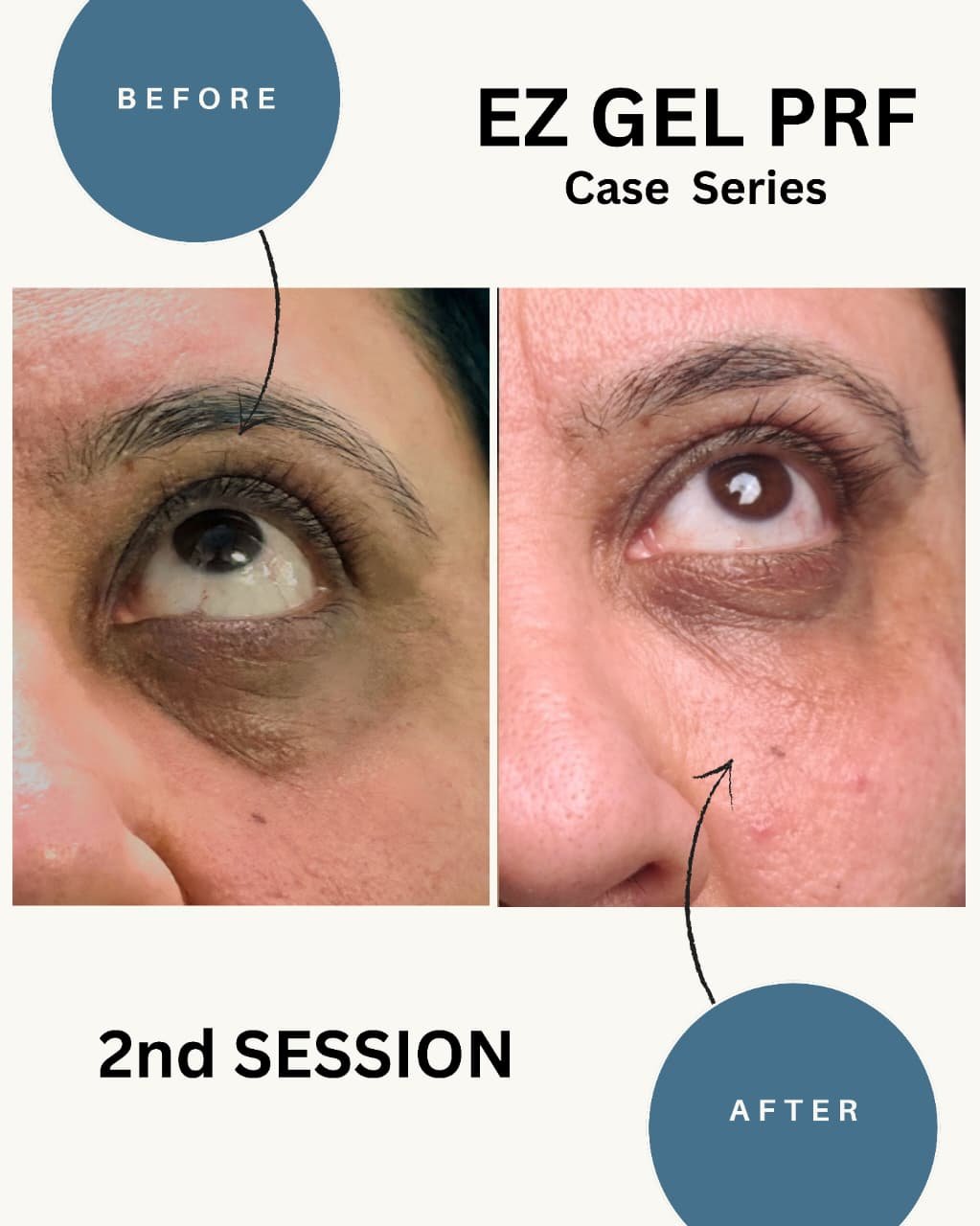 Under eye dark circles PRF before and after