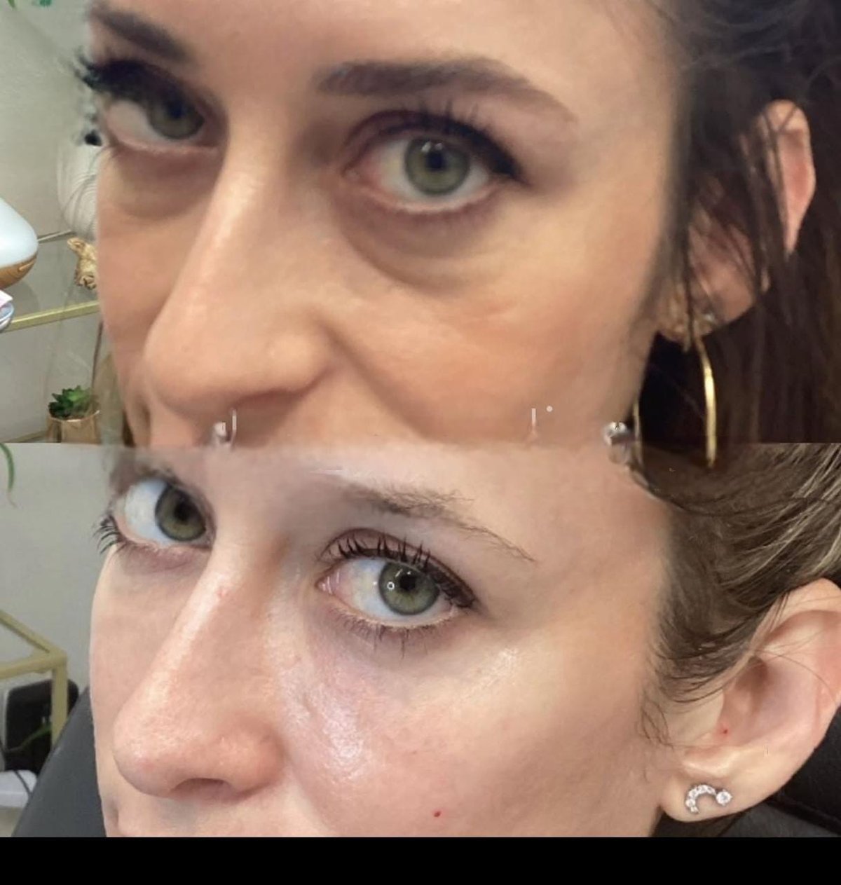 Under eye rejuvenation before and after